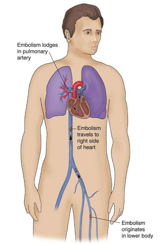 Pulmonary Embolism A blood clot that forms in the legs and breaks off, travels through the veins,