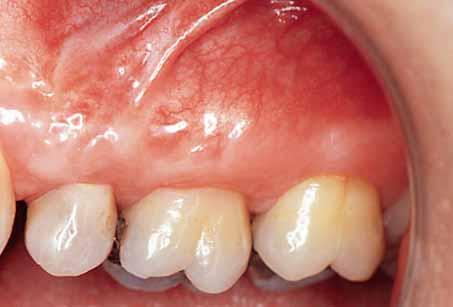 After 1 year there were no reports of new sensitivity developing in any of the treated teeth.
