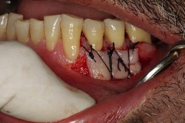 appearance at the gingival unit graft side, (F) Gingival unit graft, (G) Suturing, (H) After six months months after surgery.