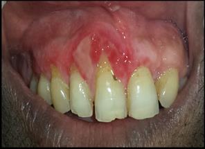 the techniques of gingivectomy/ gingivoplasty to