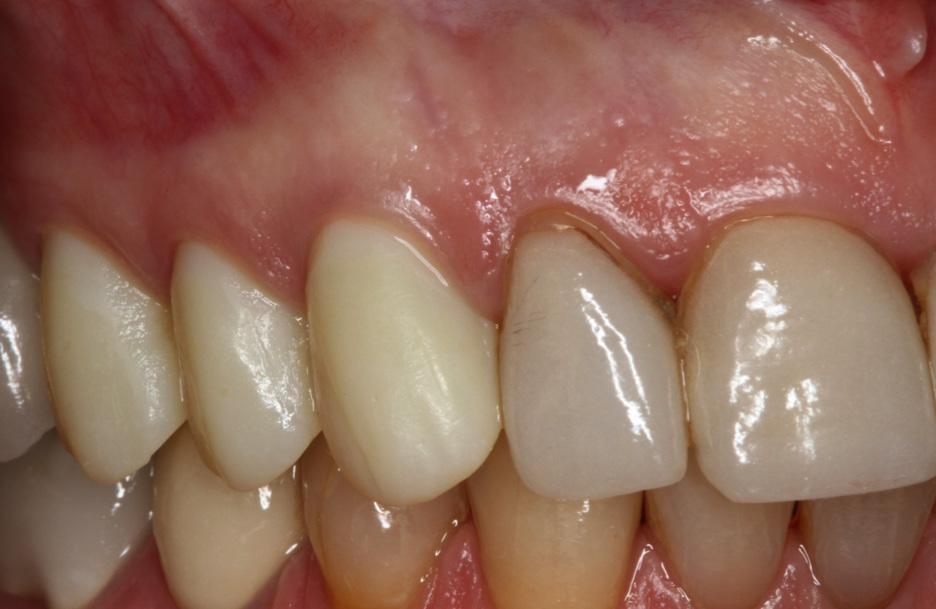 substance had occurred, which was probably due to generalized staining, but perhaps could have been a result of an increase in dentin mineralization, as caries had been ruled out as a possible cause.
