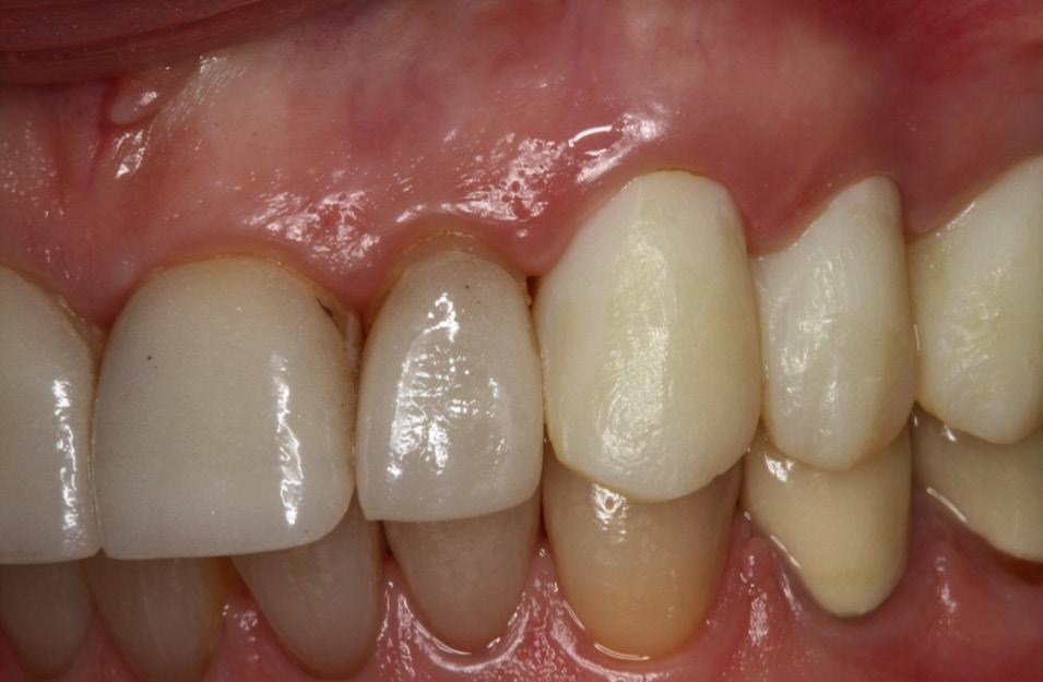 For dentin hypersensitivity to occur, not only must the dentin be exposed, but also the protective smear layer of precipitated salivary glyco-proteins and minerals which normally occlude the tubules