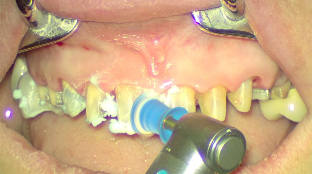 The veneers were then removed with diamond burs in an effort to avoid further reduction of the natural tooth; not knowing the thickness of the original veneers, which had been in place for many