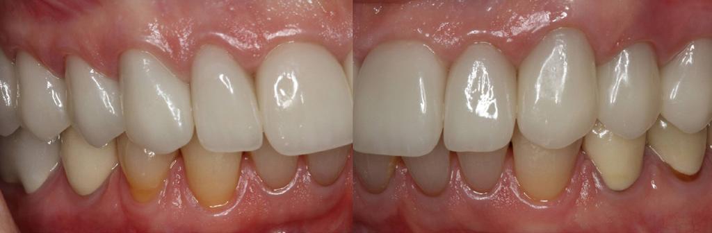 Cementation followed, with careful seating of the veneers to ensure correct contact, incisal position, and cervical and gingival adaptation and symmetry; all excess cement was removed.
