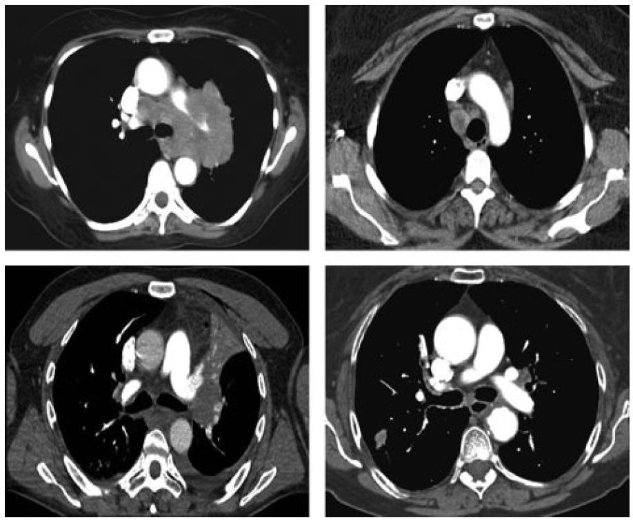 Non-Invasive Staging of the Mediastinum Provides clarity of the pulmonary abnormality Categories defined by anatomic characteristics (size, location, extent) CT is inexpensive, widely available