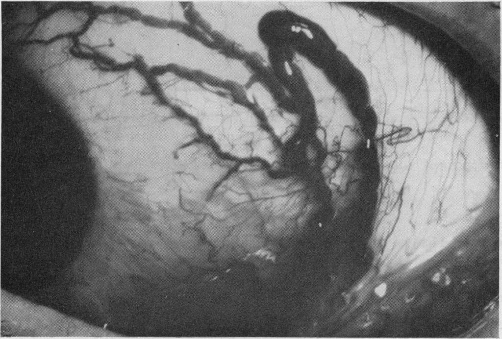 Lymphangiectasia haemorrhagica conjunctivae in the interpalpebral region. The cornea, anterior segment, lens, and fundus were normal.