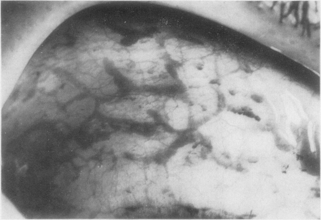 276 276 Philip Awdry This case was presented at a clinico-pathological meeting at the Institute of Ophthalmology in October, I967, and since that time four further cases of persistent oedema or