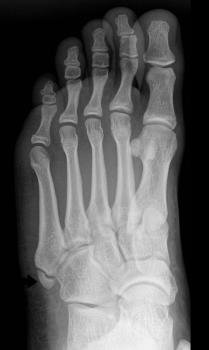 Absence of union of the secondary ossification centre of the base of the fifth metatarsal (black arrow) Imaging