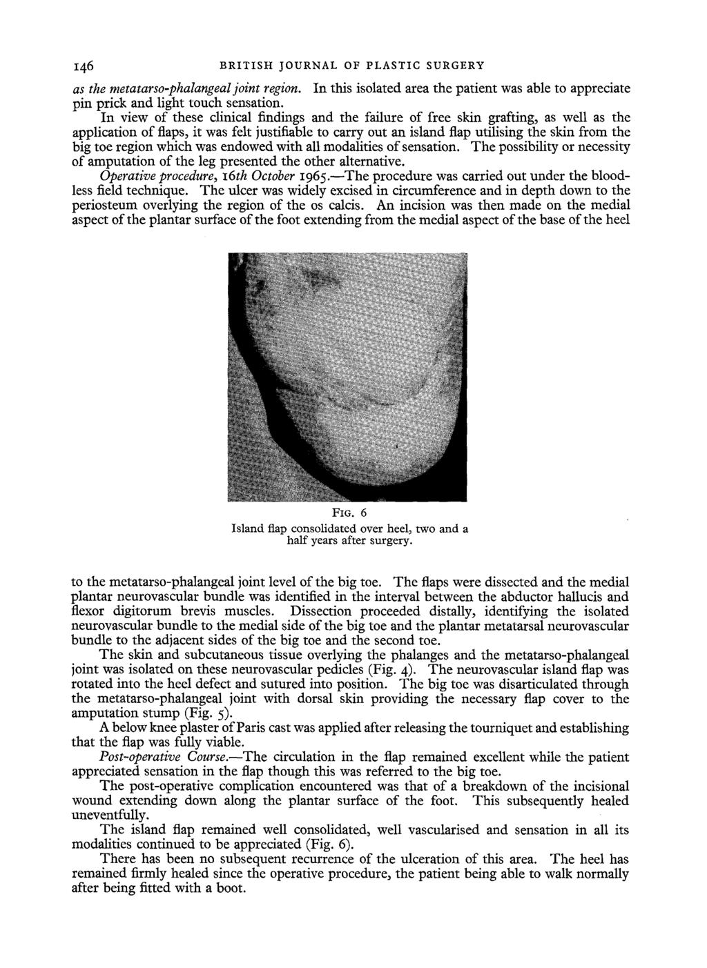146 BRITISH JOURNAL OF PLASTIC SURGERY as the metatarso-phalangealjoint region. In this isolated area the patient was able to appreciate pin prick and light touch sensation.