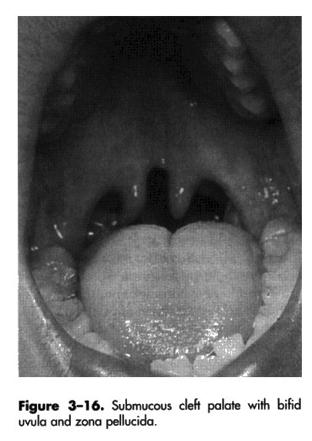 Submucous cleft palate (SMCP) SMCP- with all the signs! Three (3) classical signs Bifid uvula.