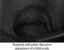 Uvula: look carefully Palatine tonsils: Are they obstructive?