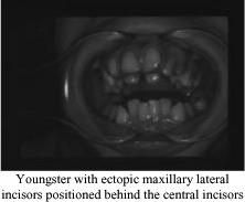 61 62 Ectopic lateral incisors Ectopic teeth 63 Occlusion: Occlusal deviations [how upper and lower jaws occlude] Overjet: protrusive premaxilla with or without Angle Class II malocclusion