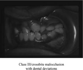 Class III/ crossbite malocclusion Dental AND Occlusal problems Dental deviations include Lingually tipped central incisors Missing teeth in