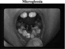 Microglossia Ankyloglossia: tongue tie Cause of bilateral