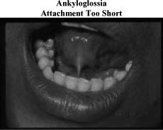 Look for associated mobility/rom problems 69 70 Ankyloglossia: