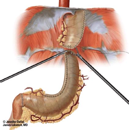 Tack Gastric Tube to Mobilized GE- Junction Tumor