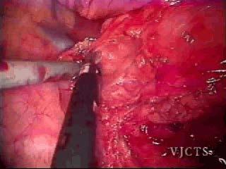 VATS Esophageal Lymph node Dissection (Video) 1) Diaphragm retracting stitch 2) Watch posterior membranous airway 3) We generally leave thoracic duct, if damaged, ligate 4) Aorta, use clips, avoid