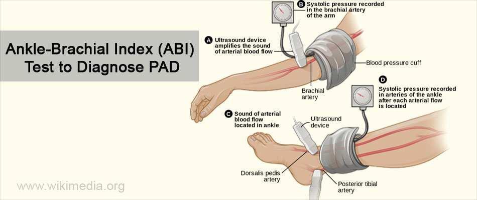 Diagnosis of Peripheral Vascular Disease Ankle brachial indices the basic test