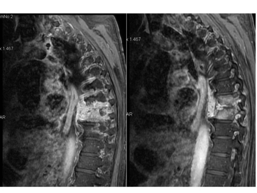Fig. 2: Spondylodiscitis in D9 and D10 vertebral bodies.