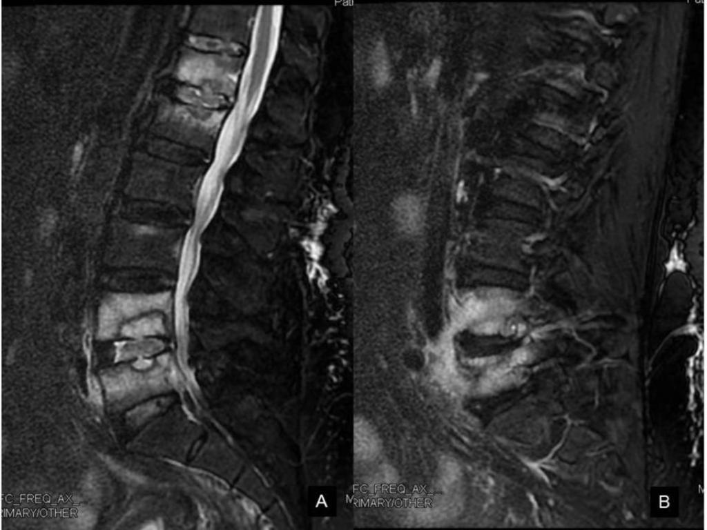 Fig. 8: Sagittal T2 Fat Sat: (A) Edema is shown in D12-L1, L3-L4 vertebrae, the intervertebral disc and Schmörl s nodes;