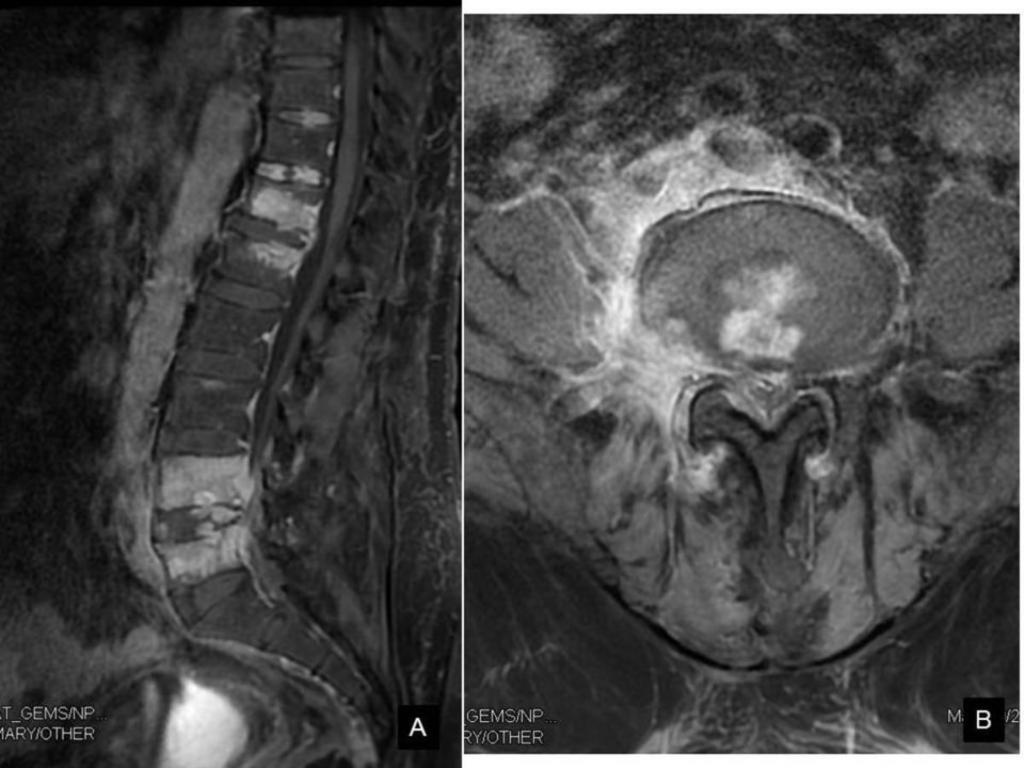 Fig. 9: Sagittal (A) and axial (B) T1 Fat Sat with IV gadolinium: Enhancement in areas of bone edema and patchy nodular pattern in L4-L5 disc.