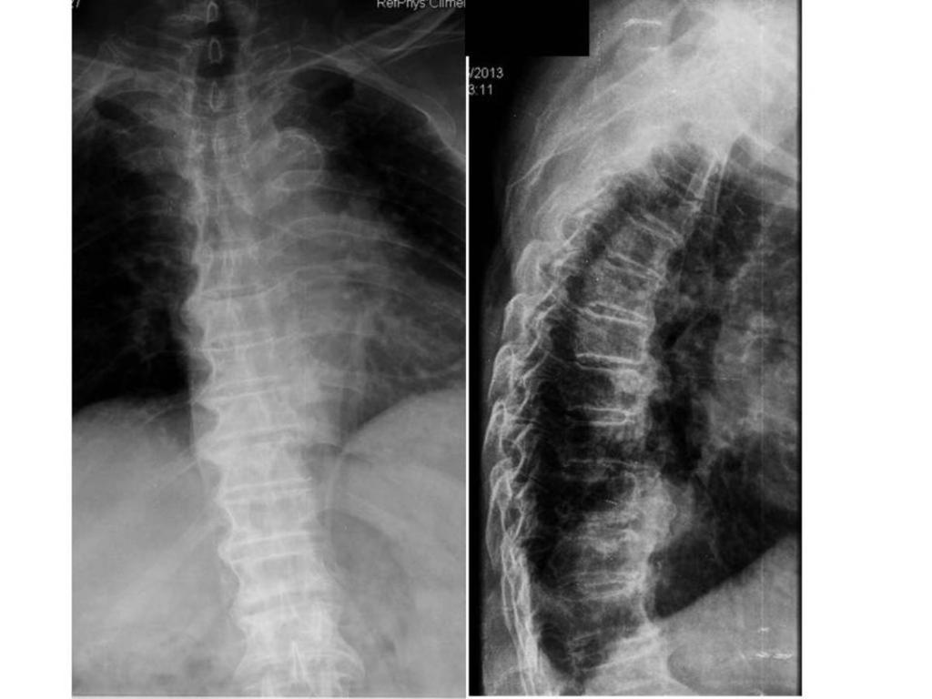 Fig. 10: AP and lateral spine X ray: large intervertebral