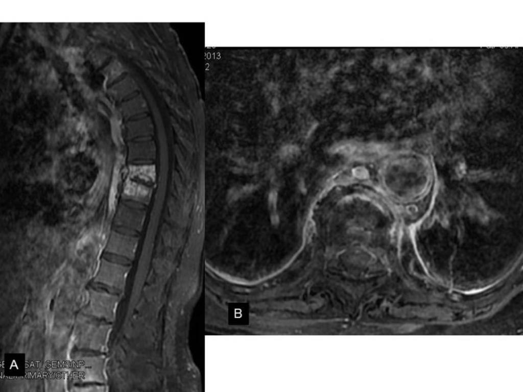 Fig. 15: (A) Sagittal and (B) axial T1 Fat Sat with IV gadolinium: Enhancement of D8 and D9 vertebrae with