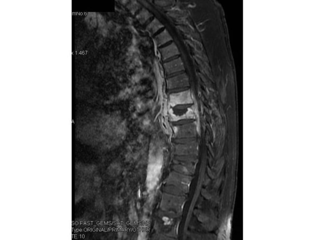 Fig. 17: Contrast-enhanced sagittal T1-weighted MR image with fat saturation exhibits amorphous enhancement in regions of fluid signal intensity noted on STIR and T1weighted images, except Kummell
