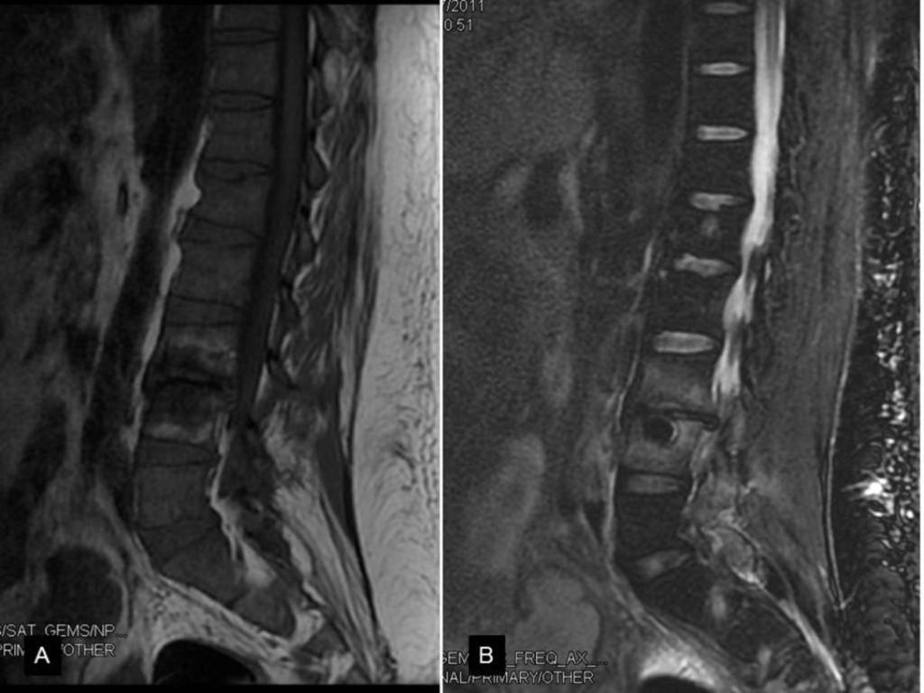 Fig. 18: Sagittal (A) T1 and (B) T2 with fat saturation weighted MR image show extensive bone edema in vertebral body of L3 and L4; irregularity with erosions is also observed in the inferior