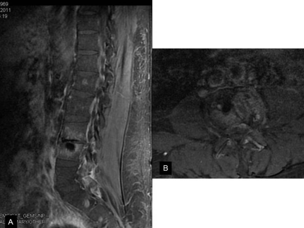 Fig. 19: Contrast-enhanced (A) sagittal and (B) axial T1-weighted MR image with fat saturation exhibits enhancement in regions of fluid signal intensity noted on
