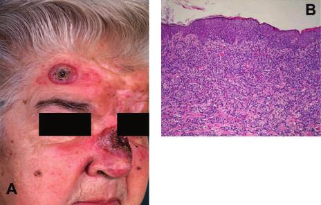 M. Paulli et al. Figure 9A. Aggressive epidermotropic CD8 + cytotoxic lymphoma: the patient presents a typical nodular lesion with a central necrotic area on the right temporal area. B.