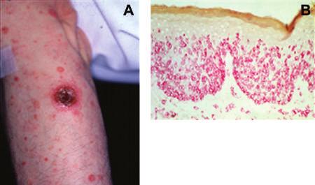 Cutaneous T-cell lymphomas Figure 10 A. Cutaneous γ/δ T-cell lymphoma. The ulcerated, necrotic nodule is localized on the arm. B.