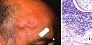 M. Paulli et al. Figure 1. A. Mycosis fungoides (MF) associated follicular mucinosis: the patient presents erythematous papules and plaques involving the head. B.