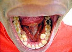 Aguiar et al. Supernumerary Teeth Associated with Gemination 137 1 2 3 4 5 6 7 Slika 1.