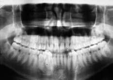 mandible. Slika 3. Prekobrojni zubi na okluzalnoj snimci Figure 3 Appearance of supernumerary teeth in an occlusal radiograph. Slika 4.