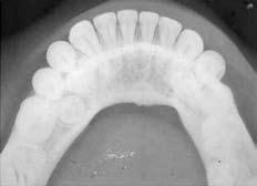 Izgled prekobrojnih zuba nakon ekstrakcije; kod jednoga se vidi promjena oblika Figure 5 Appearance of supernumerary teeth after extraction, showing shape alteration