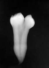 Fuzija se definira kao spajanje dvaju zubnih zametka koji izrastu u obliku jedther gemination or fusion (Figures 5 and 6).