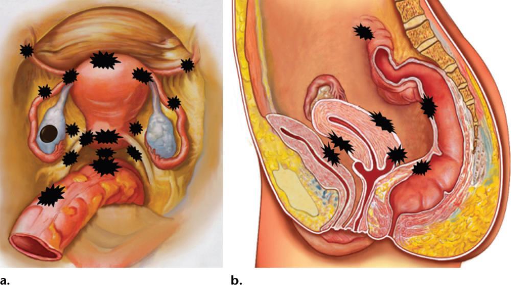 Joonistel on näidatud naise vaagna anatooma aksiaal- (a) ja sagitaaltasapinnas hulgaliste endometrioosi kolletega.