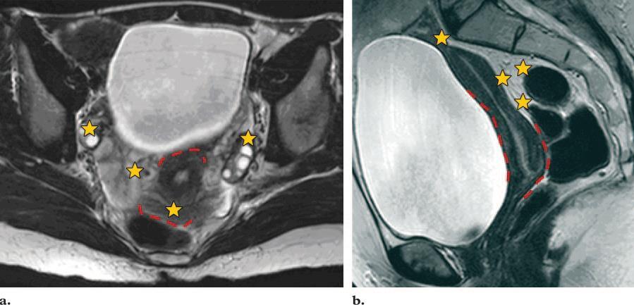 Ax (a) ja Sag (b) T2 kujutisel on näidatud sagedasemad peritoneaalse endometrioosi kohad munasarja-, emaka-, soole pinnal ja Douglase õõnes (kollased