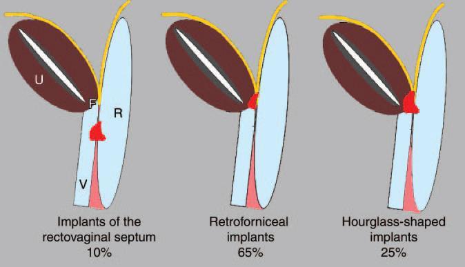 Rektovaginaalse septi endometrioosi kollete klassifikatsioon. Punane laik süvaendometrioosi kolle, kollane joon vistseraalne peritoneum.