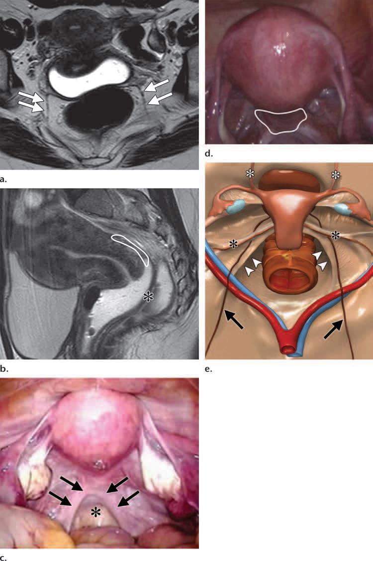 Normaalne naise vaagna anatoomia. (a, b) Ax (a) ja sag (b) T2-kaalutud kujutis: uterosakraal ligamendid (avalged nooled), rektovaginaalne tasku (b - *) ja retrotservikaalne ala (b valge joon).