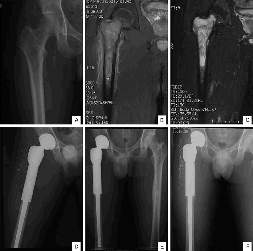 Figure 2. Case presentation: A 24-year-old male patient with Ewing s sarcoma in right proximal femur. A. Preoperative radiograph; B. MRI T2 image obtained before chemotherapy; C.