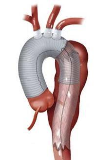 Current treatment outcomes for Complex aortic arch Open surgical repair Longer hospital stays Younger,