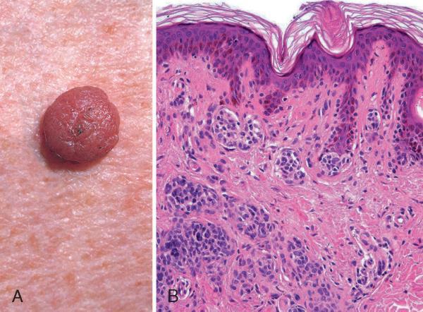 Melanocytic nevus, compound type (A) the compound nevus is more raised and dome-shaped.