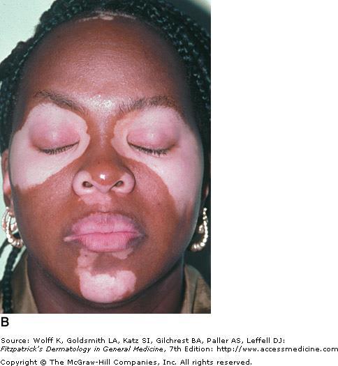 Patch A small well-defined area of the skin distinct in color