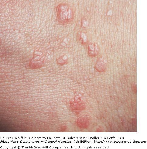 Papule Multiple, well-defined papules of varying sizes are seen