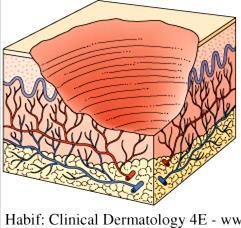 Ulcer Focal loss of epidermis and dermis Loss does