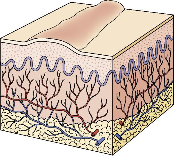 Scar - An abnormal formation of connective tissue implying