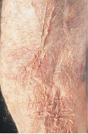 Atrophy Depression of the skin Results from thinning of