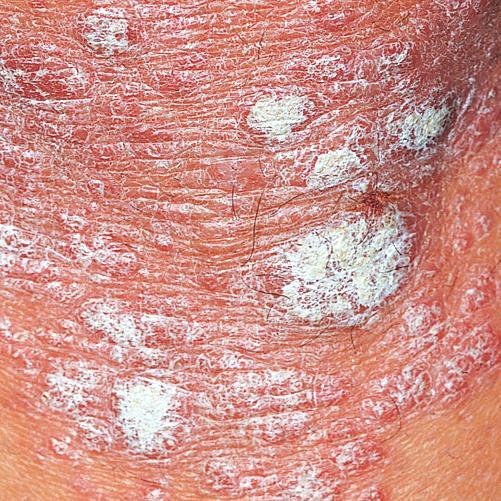 Psoriasis (silvery) Habif: Clinical Dermatology,